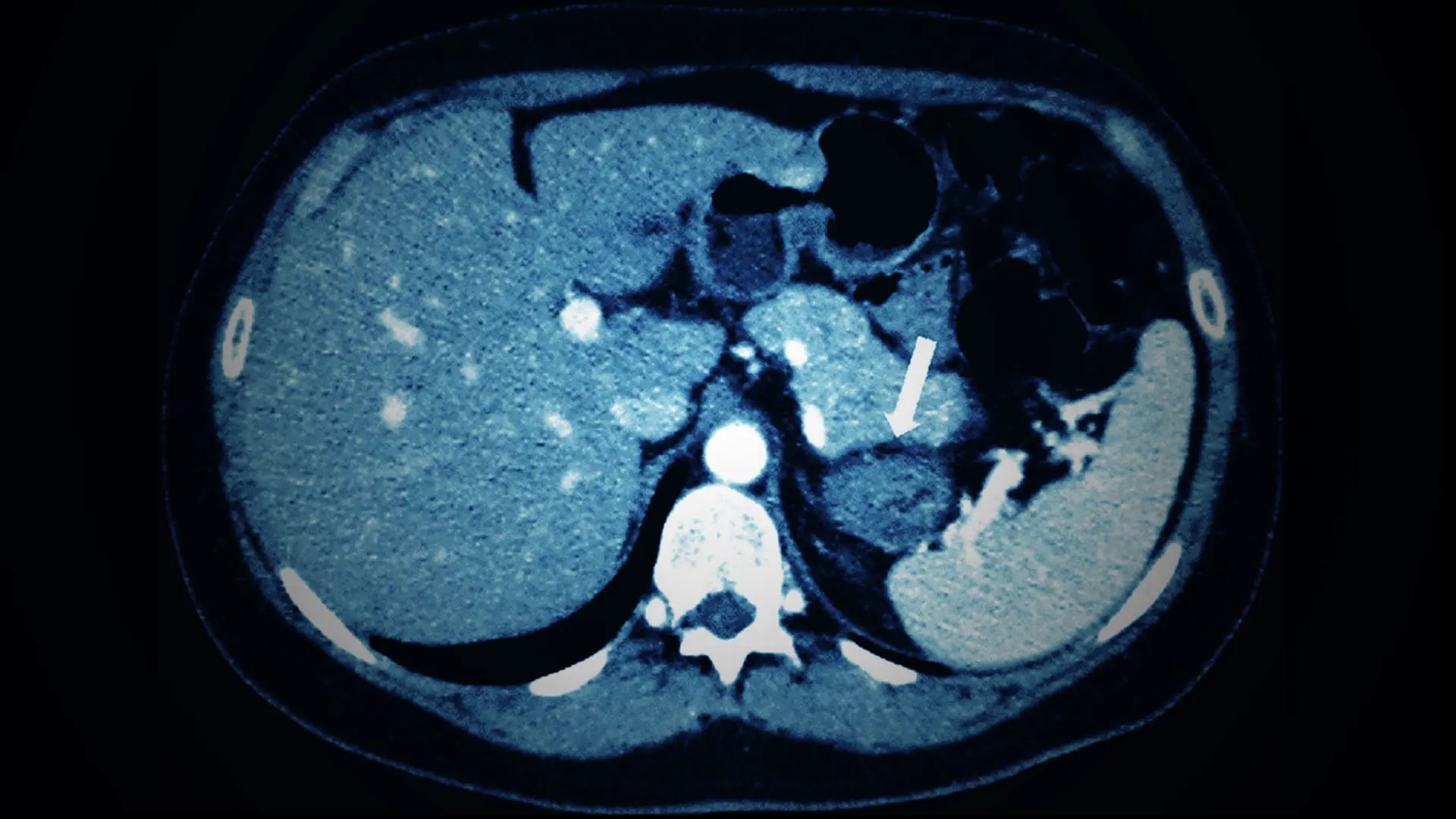 Pilot Study Will Repurpose an Oral Antagonist to Treat Cortisol Excess 