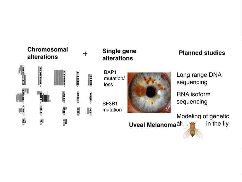 The development of uveal melanoma is accompanied by large-scale chromosomal changes and smaller mutations, including single base-pair changes in genetic drivers such as BAP1 and SF3B1. Long-range sequencing, modeled in the fruit fly, will permit an in-depth analysis of the DNA alterations that occur. 

   





