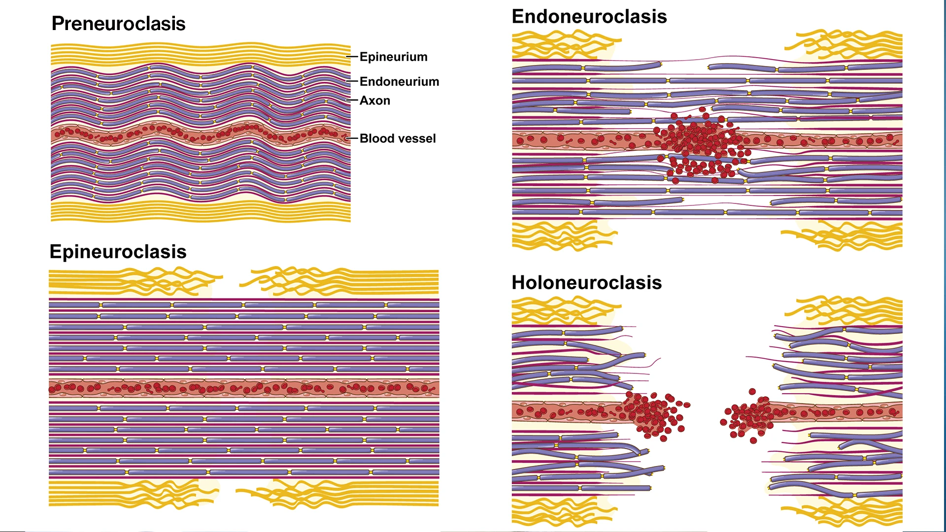 Illustration showing the four levels of neuroclasis: preneuroclasis, epineuroclasis, endoneuroclasis, and holoneuroclasis. The rat median nerve follows an "outside-in" sequence of structural failure, starting at the epineurial sheath and ending at the axonal level.