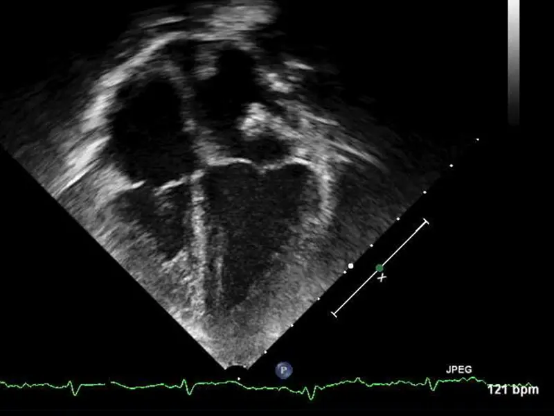 Echocardiogram, s/p orthotopic heart transplantation, showing normal biventricular size.







