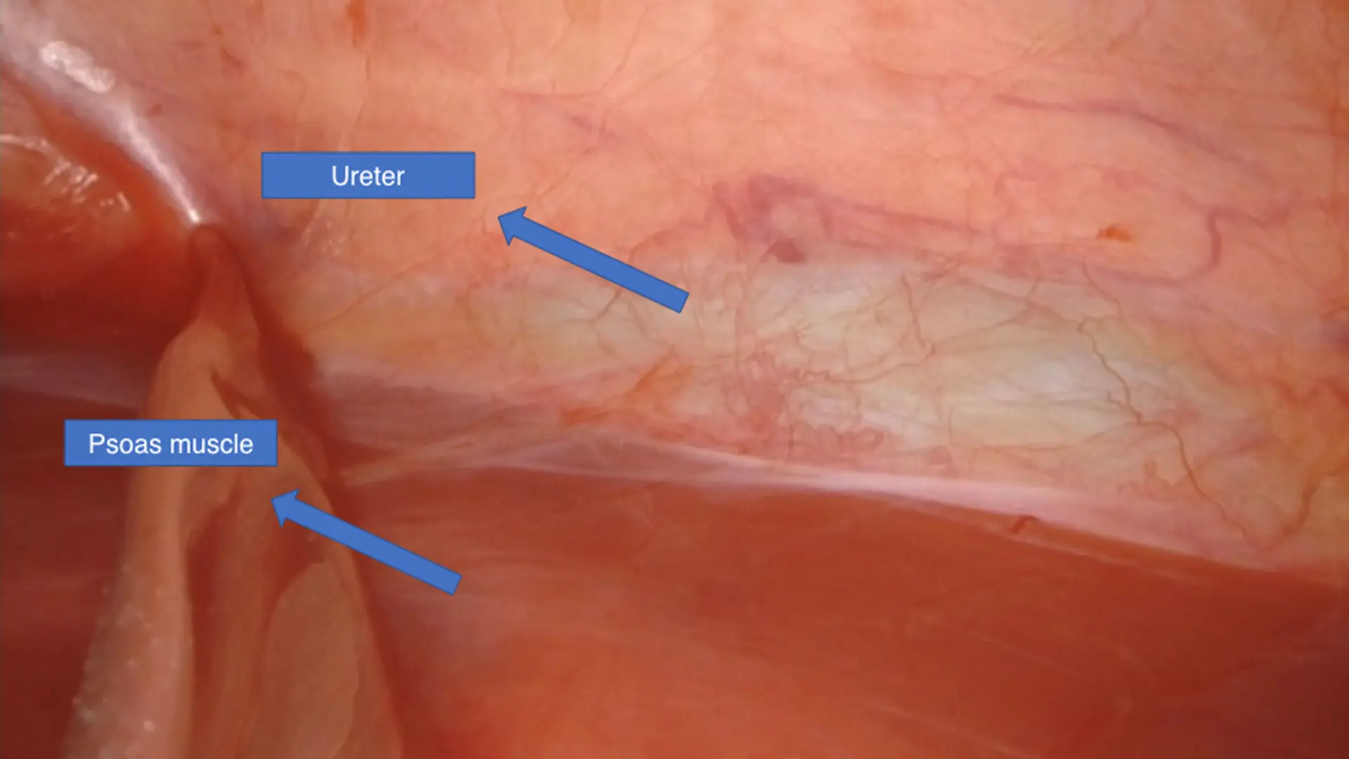 Balloon dilator used to create the retroperitoneal space