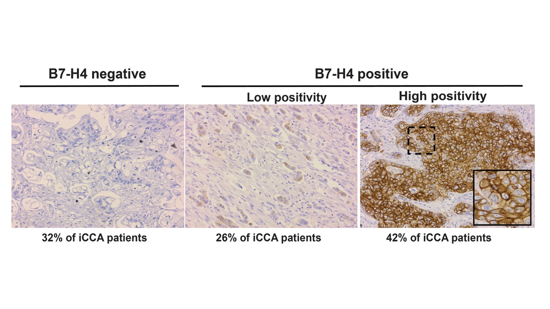 An immunostaining is used to assess the protein expression of B7-H4 in an internal cohort of cholangiocarcinoma samples. Examples of negative, low, and high positivity are shown.