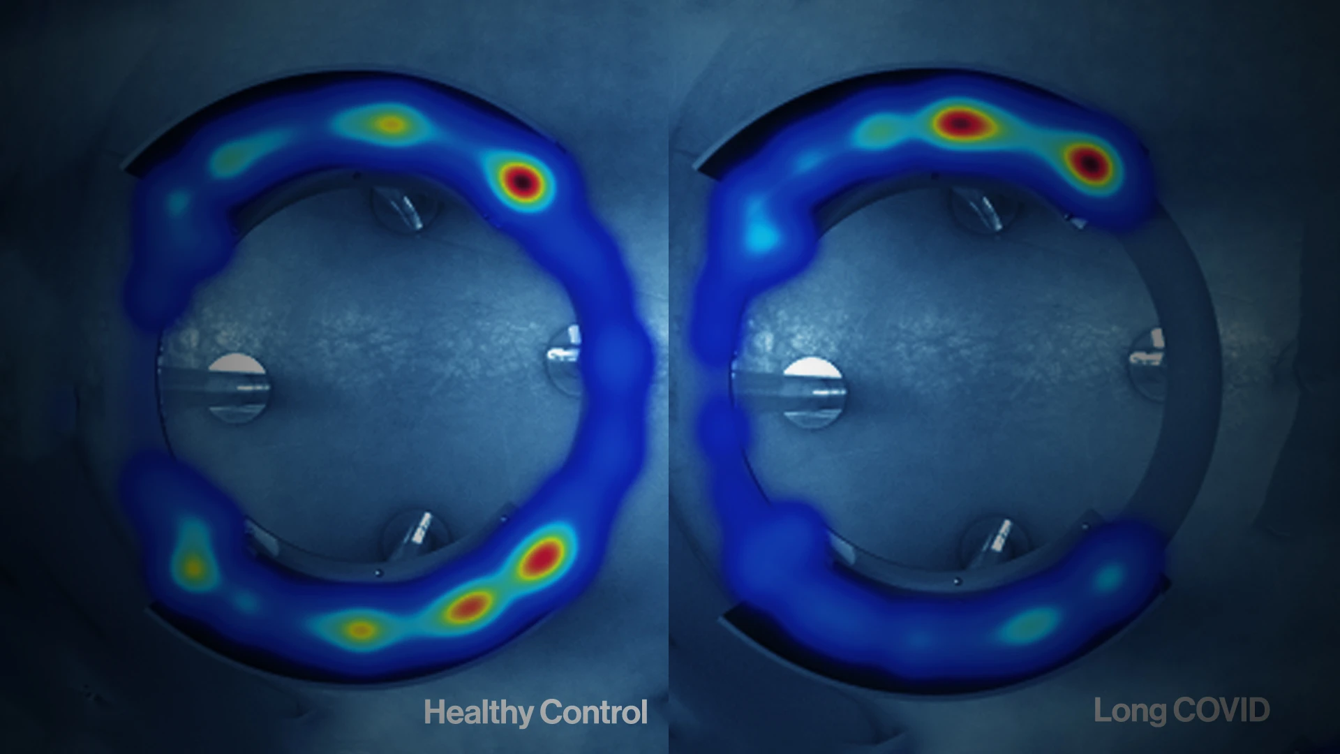 Breaking Ground on Long COVID's Impact on Biology and Its Immunologic Basis