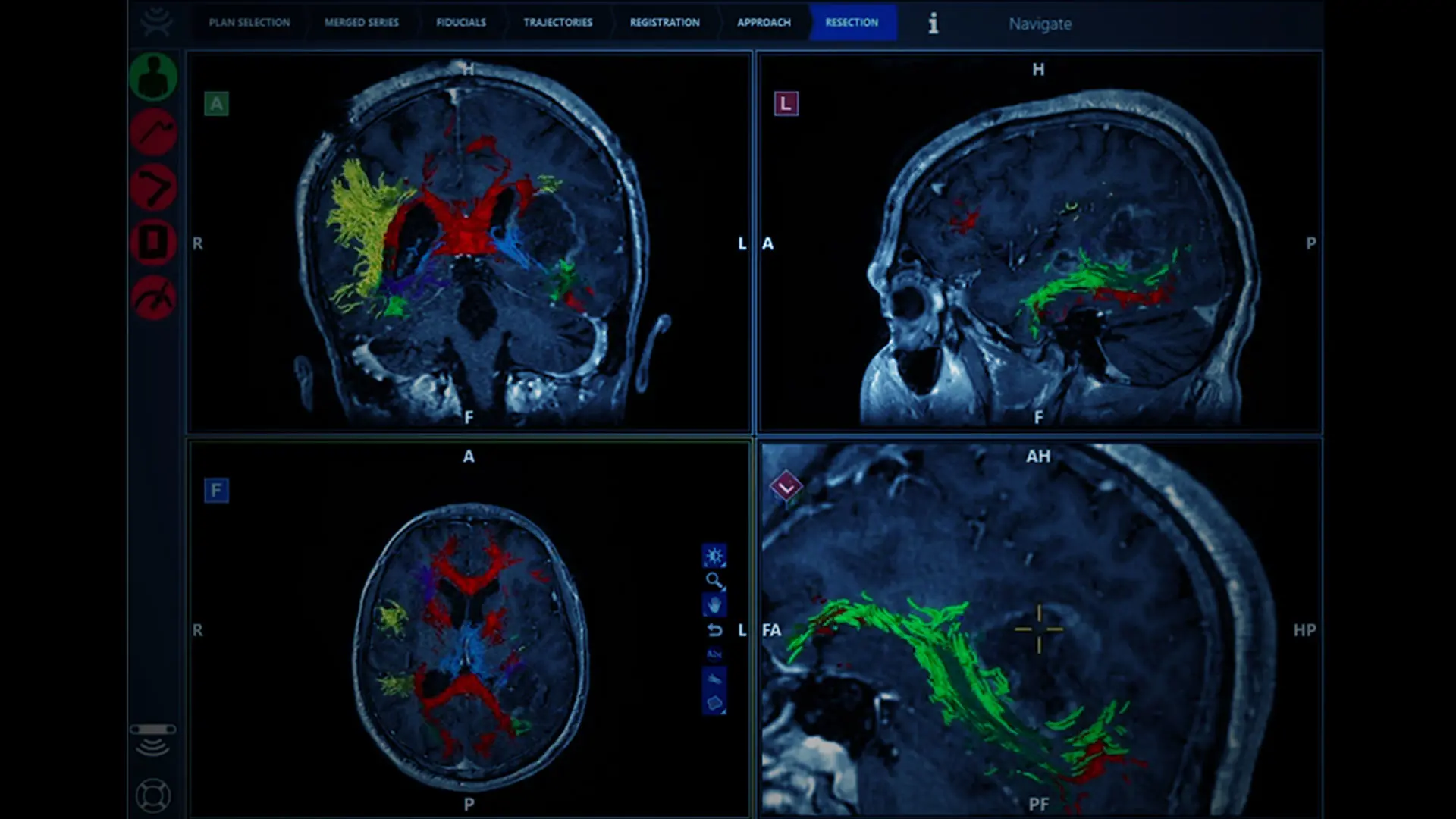 Contemporary Intraoperative Visualization for Glioblastoma With Use of Advanced  Operating Room Technology