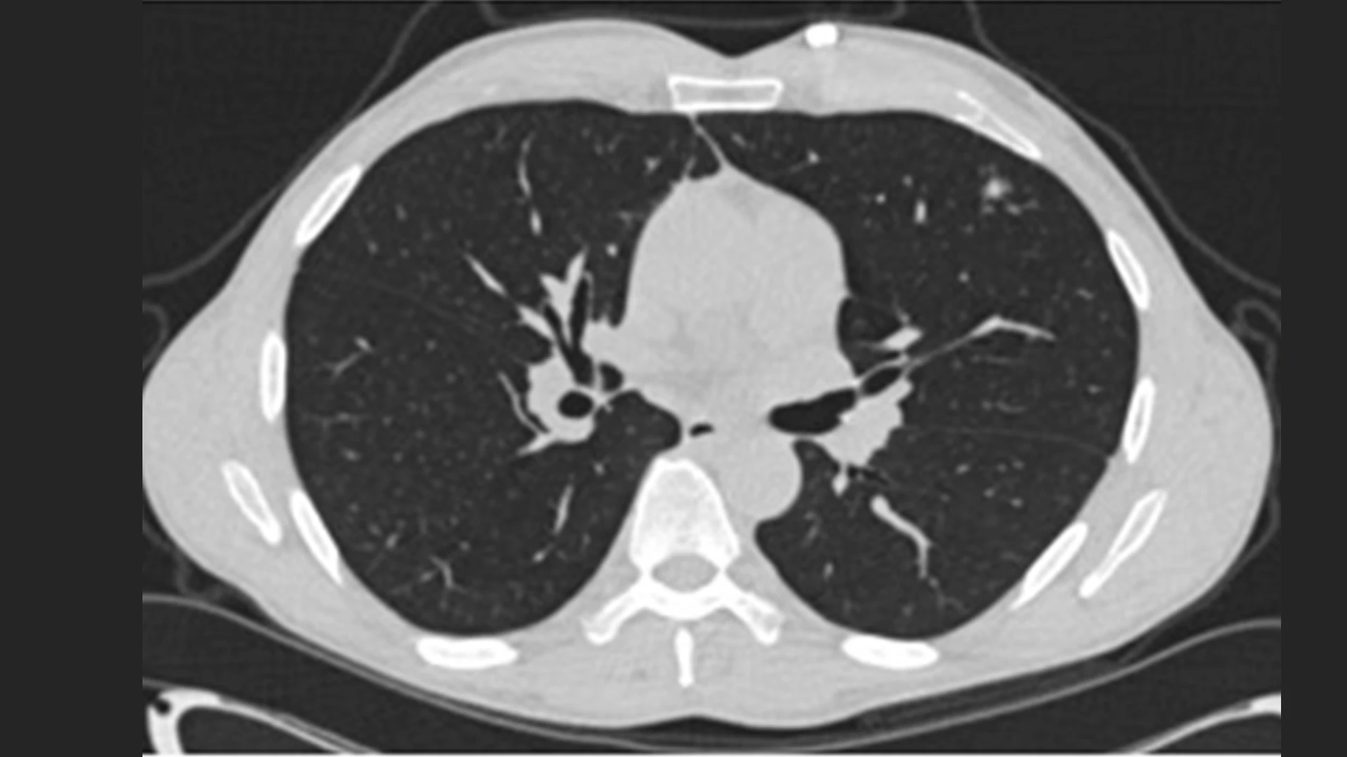 The patient's full chest CT confirmed the nodule in the left upper lobe.