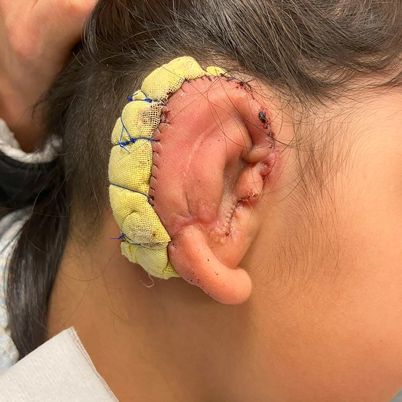 During the second stage of microtia reconstruction, the framework is elevated. Rib cartilage that is banked under the skin is used to wedge the framework forward and a skin graft is placed over vascularized tissue.
