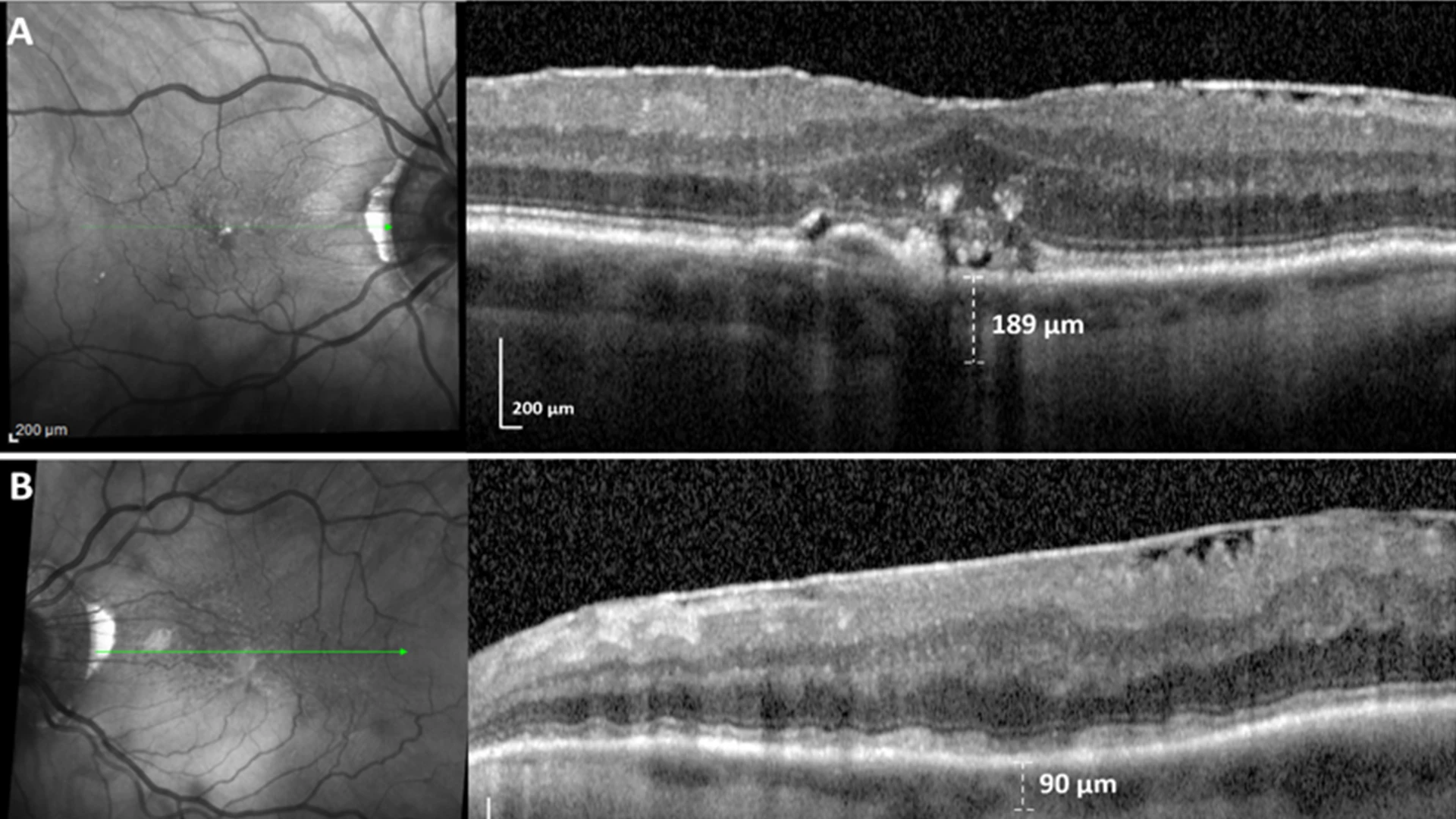 Unilateral SDDs caused by a dose response to unilateral internal carotid artery (ICA) stenosis.(A) SD-OCT scan, right eye, downstream of mild right ICA stenosis, shows no SDDs and a few drusen. (B) SD-OCT scan, left eye, downstream of moderate left ICA stenosis, shows confluent SDDs and choroidal thinning significantly associated (p=0.002, p=0.008) with ipsilateral ICA stenosis in a dose response to moderate (> 50%), not mild, ICA stenosis.