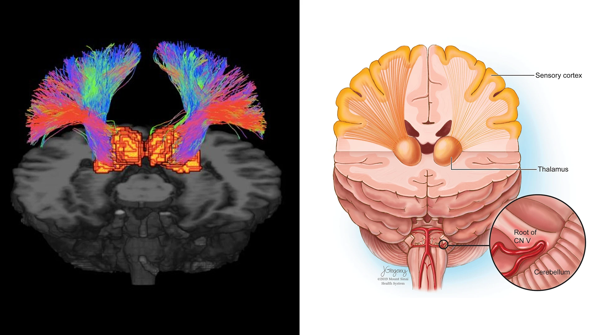 Figure 3. Probabilistic tractography of the thalamic-somatosensory tracts. Trigeminal neuralgia (TN) patients exhibited reduced integrity of these tracts on the ipsilateral side when compared to controls. These depict the white matter tracts connecting the thalamus to the somatosensory cortex in TN, a debilitating neuropathic pain condition that is often misdiagnosed due to lack of etiological understanding. 7-T diffusion weighted MRI (dMRI) is ideal for detecting changes in microstructure and integrity of white matter tracts and nerve fibers.