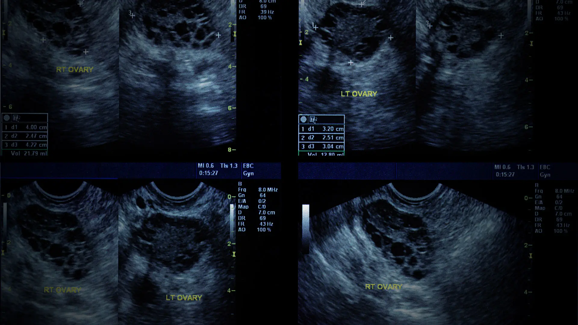 Gaining Genomic Insights Into the Mechanisms and Classification of PCOS