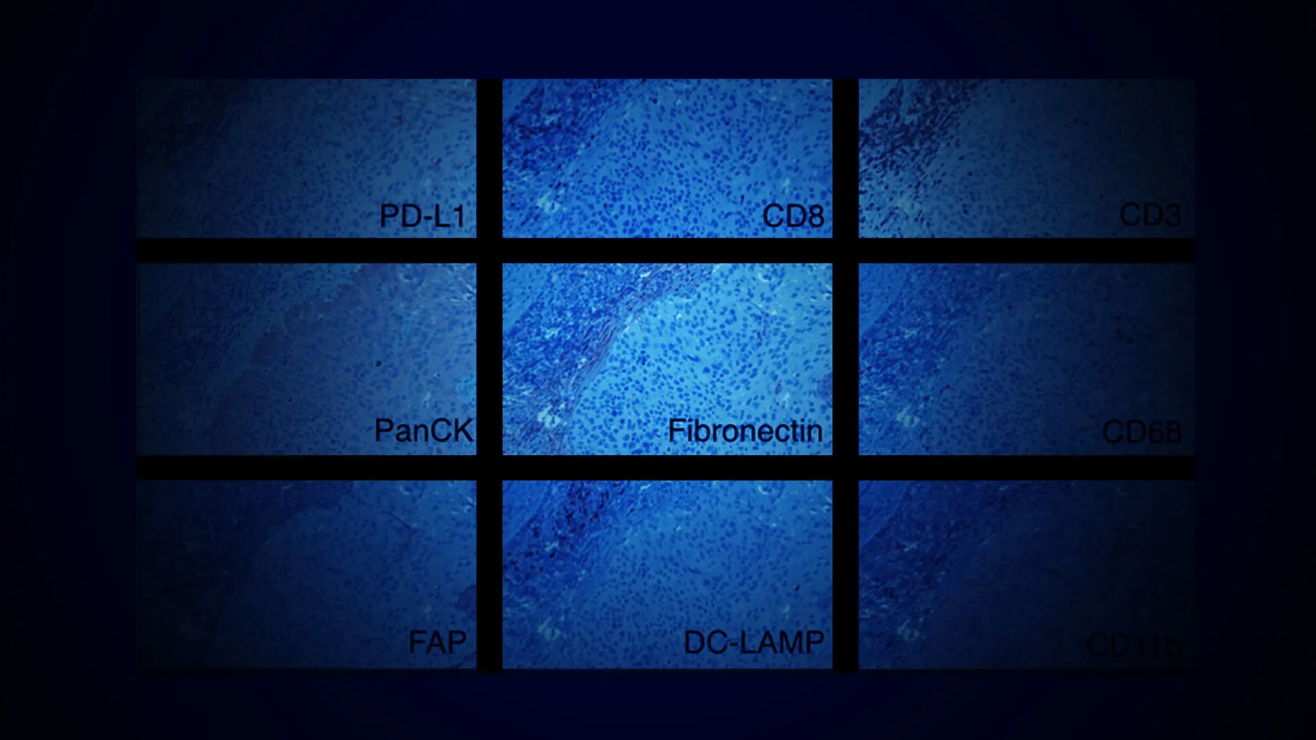 The Adjuvant Use of Immunotherapy for Bladder Cancer  