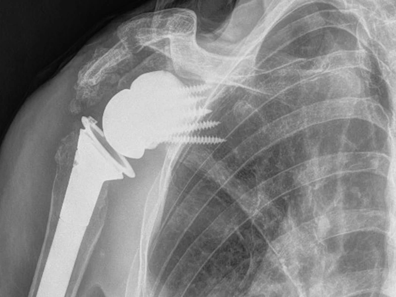 X-ray of a patient's shoulder after undergoing 3D-shoulder arthroplasty.