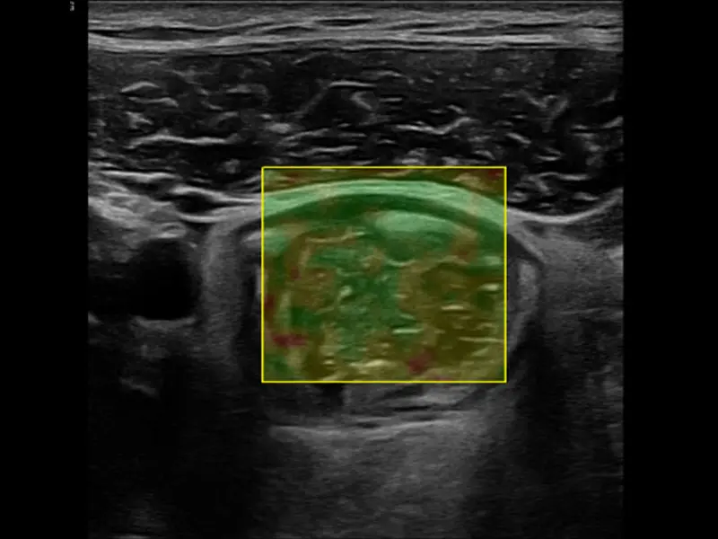 Intestinal Ultrasound Ushers In New Era of IBD Treatment