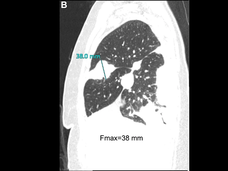 Sagittal image revealing fissure involvement by tumor; maximal fissure thickness Fmax=38 mm