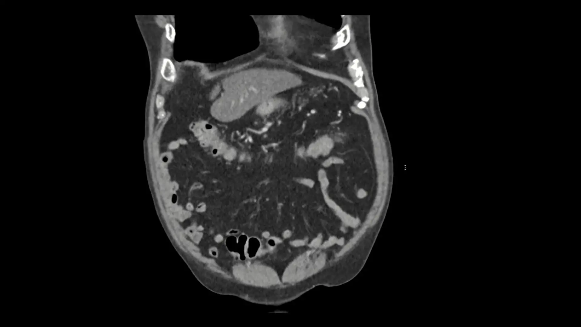 Robot-Assisted Surgery Is an Effective Approach for Treating Upper Tract Urothelial Cancer in Patient With a Horseshoe Kidney 