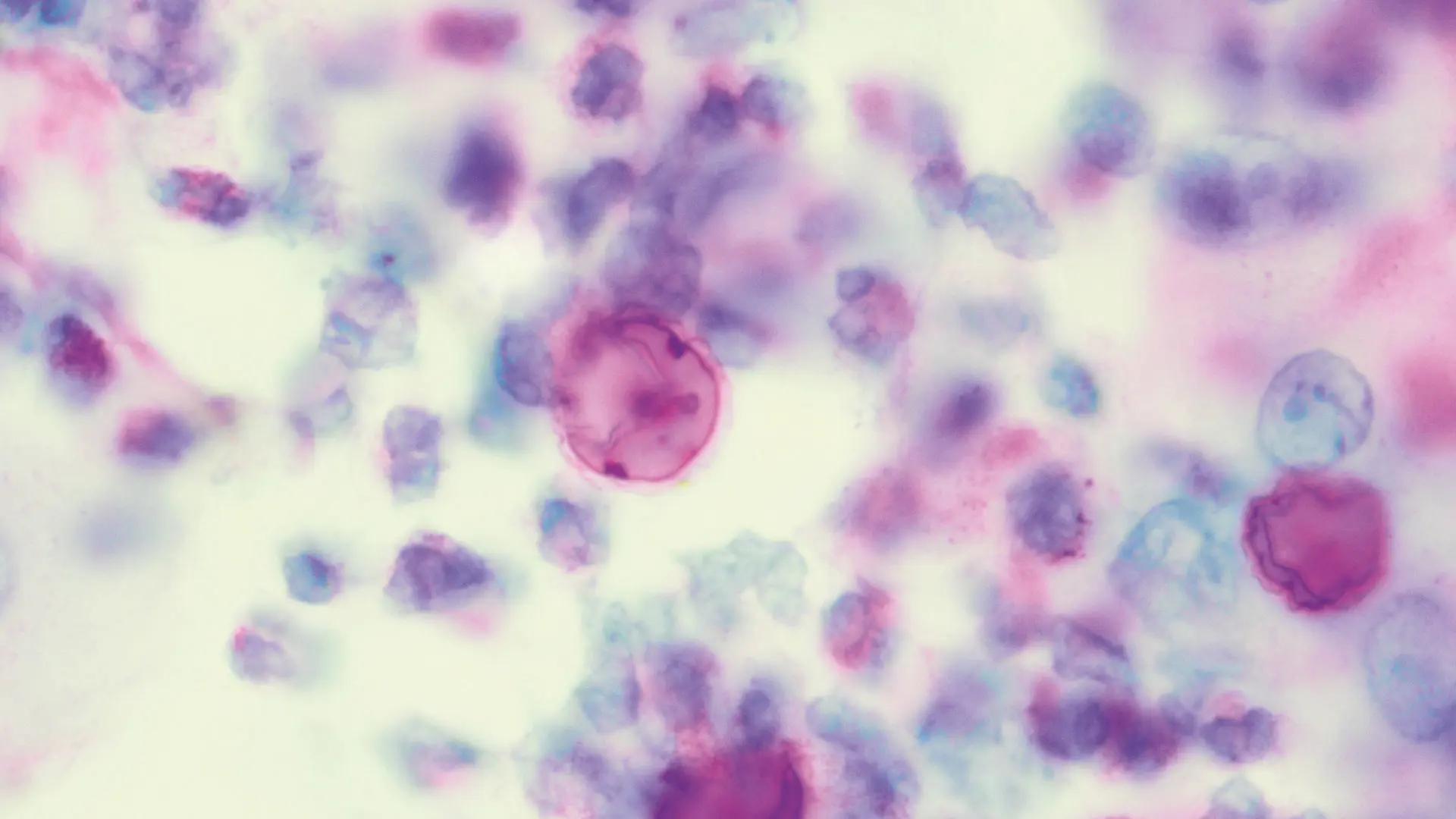 Oil immersion optic microscopy with Periodic Acid Schiff staining shows an unstained thick
capsule of Acanthamoeba cyst with internal labeling of cuticle and organelles in the acute inflammatory background (cytology, original magnification 1000x).