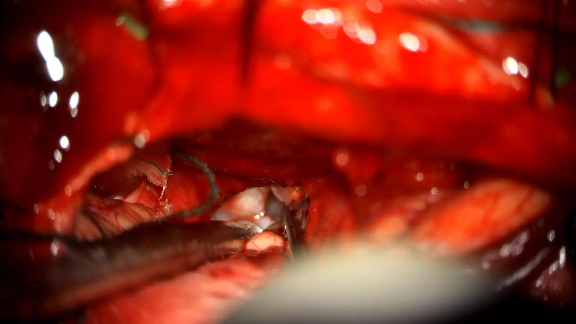 A posterior interhemispheric transcallosal approach was used to access the residual tumor in the third ventricle.