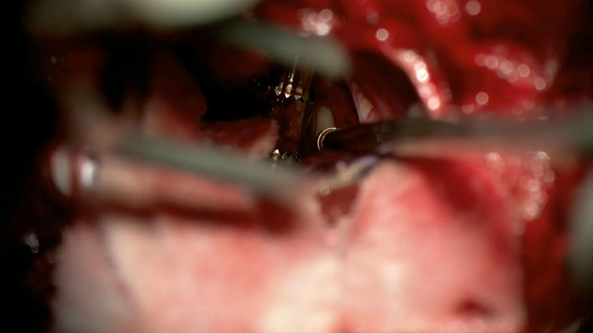 An infratentorial supracerebellar approach was used to debulk the tumor. The third ventricle is seen at the tip of the suction over the top of the cerebellum after the tumor has been partially resected.