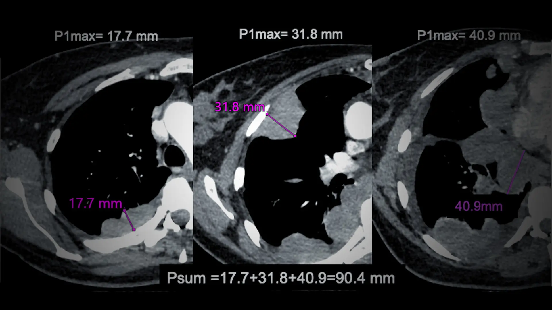 Thickness Is Key to New Staging System for Pleural Mesothelioma