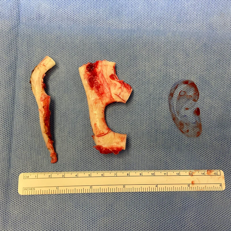 A template is created using a normal ear. Three pieces of rib cartilage are harvested to create a new ear framework.