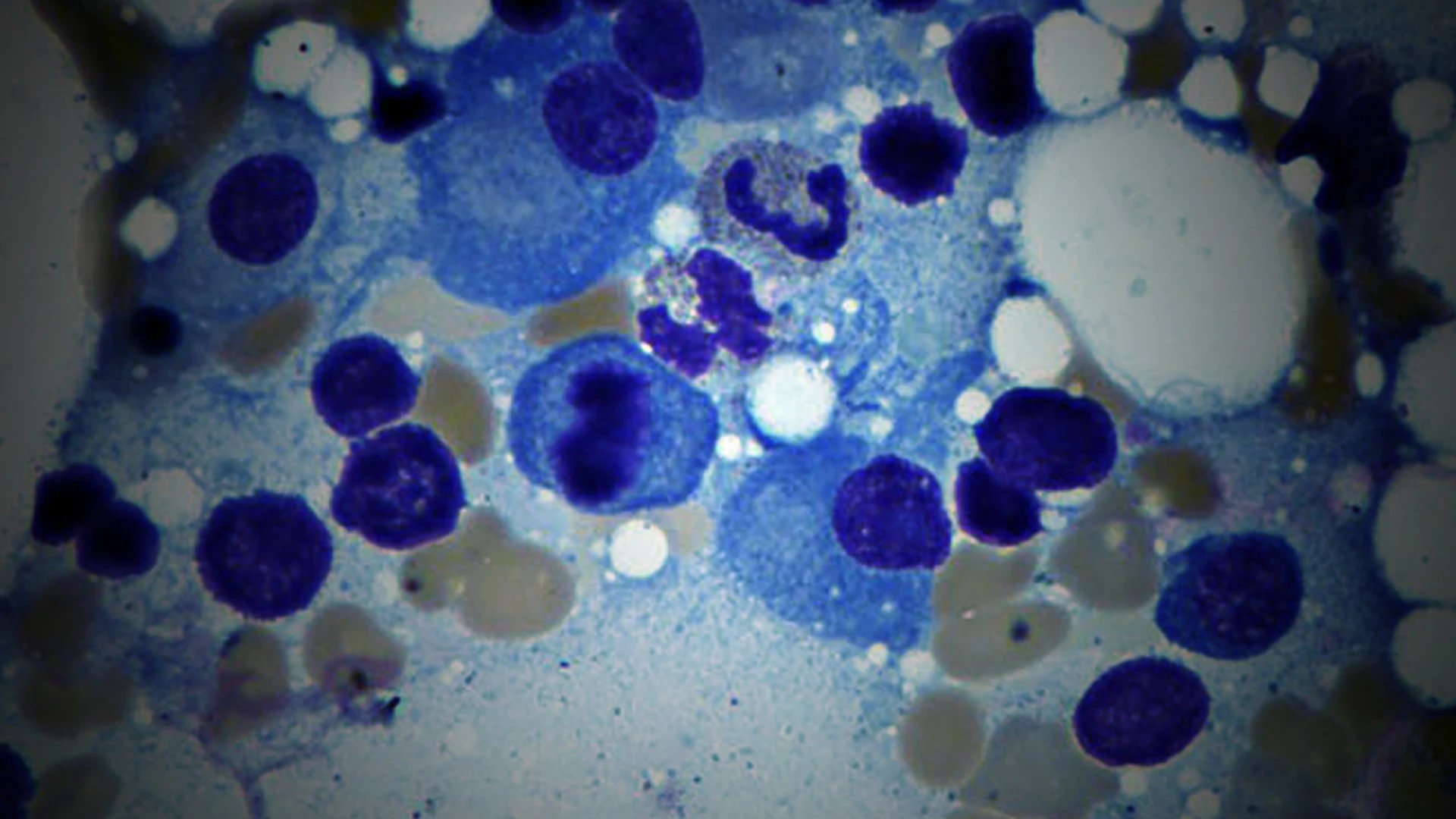 With New Treatment Strategies, a Cure for Multiple Myeloma Is Now Possible