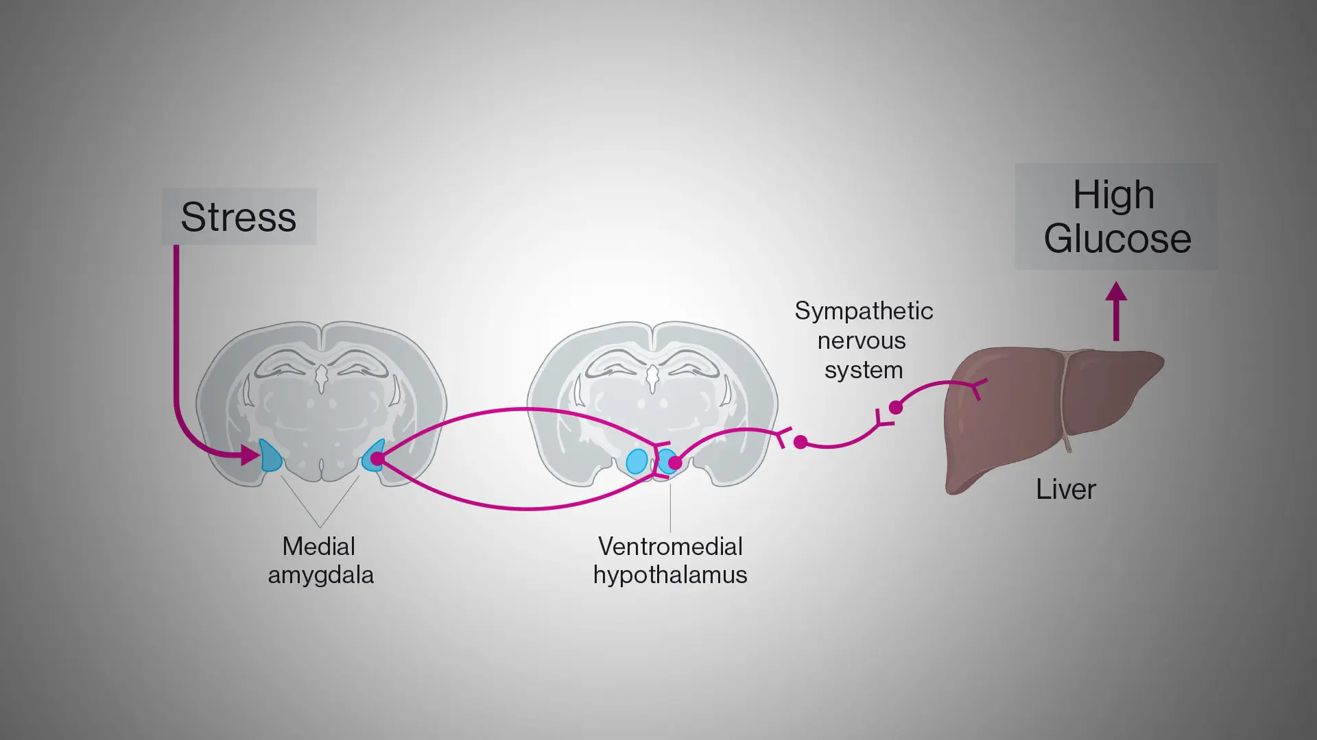Mount Sinai Study Discovers Potential Link Between Stress and Type 2 Diabetes