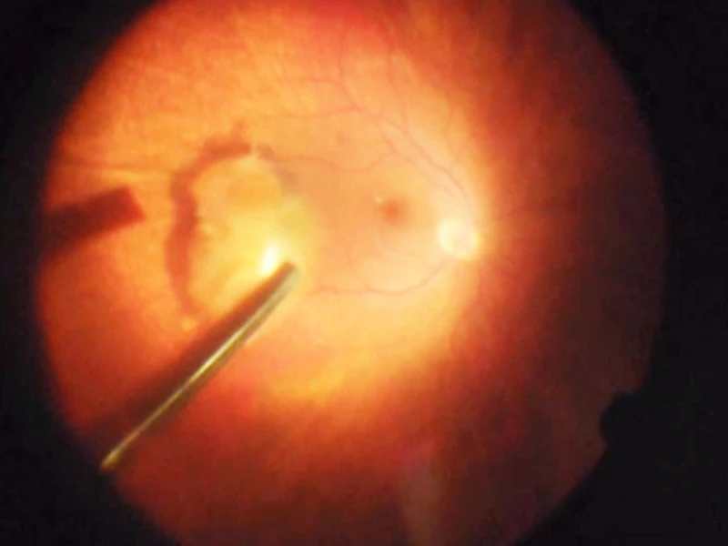 Lens sitting on the retina after falling to the back of the eye due to weak support structures (zonules), creating a blockage that prevented aqueous fluid circulation and drainage from the eye. 