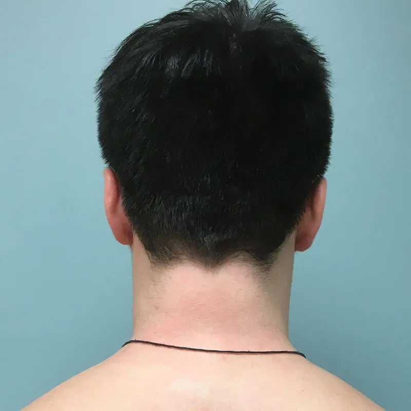 Patient with alopecia areata after treatment with JAK inhibitor