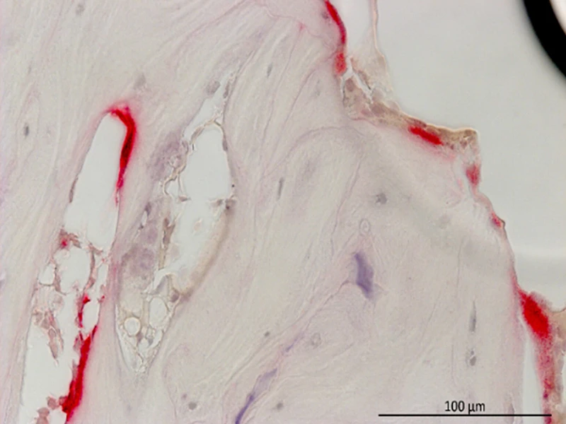 Tartrate-resistant acid phosphatase (TRAP) staining for osteoclasts (red) of serpinA1ac global knockout lining the trabecular bone. Scale bar: 100 µm.