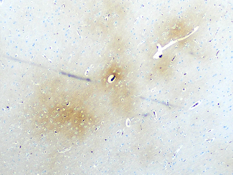 Figure 1. Fibrinogen around microvessels (brown staining on left) in the frontal white matter indicating acute vascular injury; iron deposition (blue staining on right) in right thalamus with subthalamic nucleus marking the site of remote trauma-induced red blood cell breakdown.