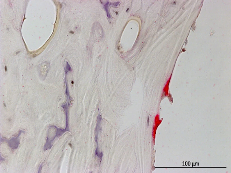 Tartrate-resistant acid phosphatase (TRAP) staining for osteoclasts (red) of (left) wildtype and (right) serpinA1ac global knockout lining the trabecular bone. Scale bar: 100 µm.