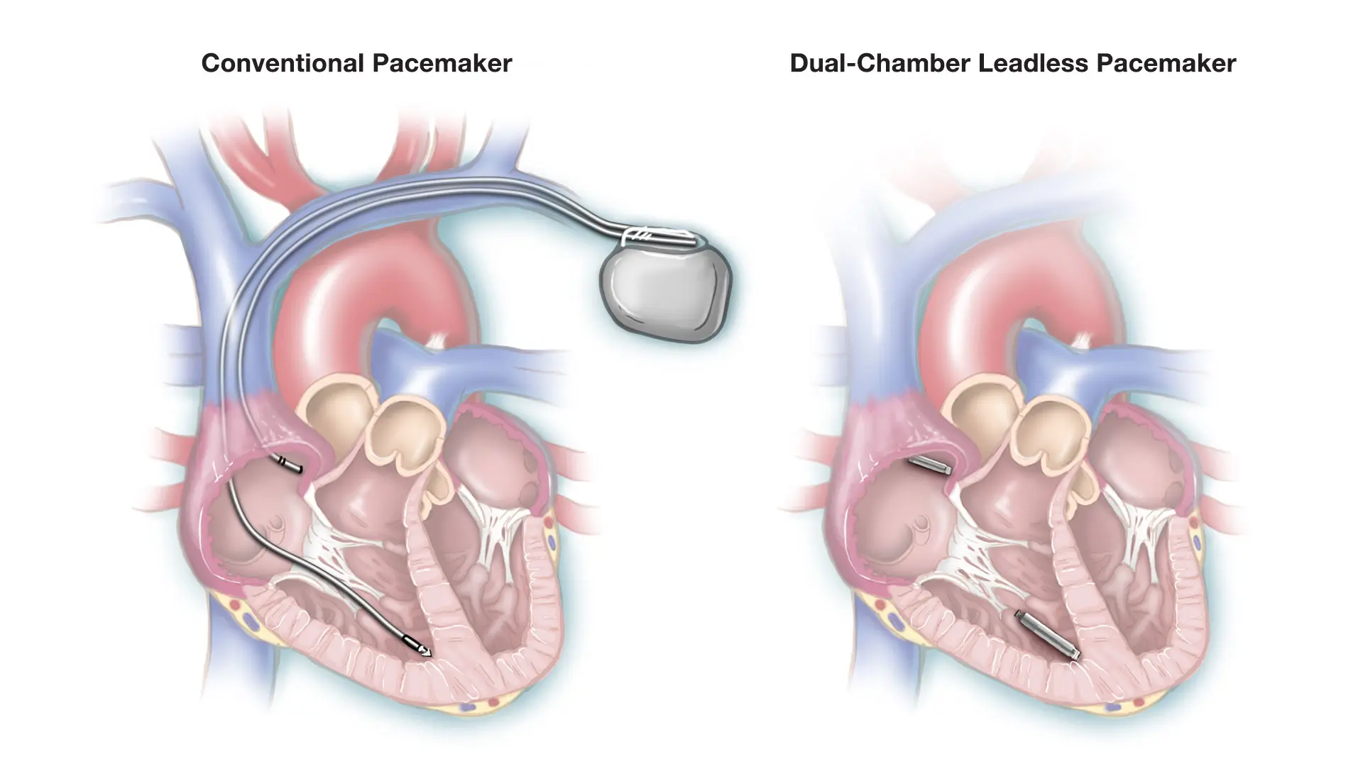A traditional system with leads and pacemaker generator, left, and the leadless system with two devices that communicate with each other. 



