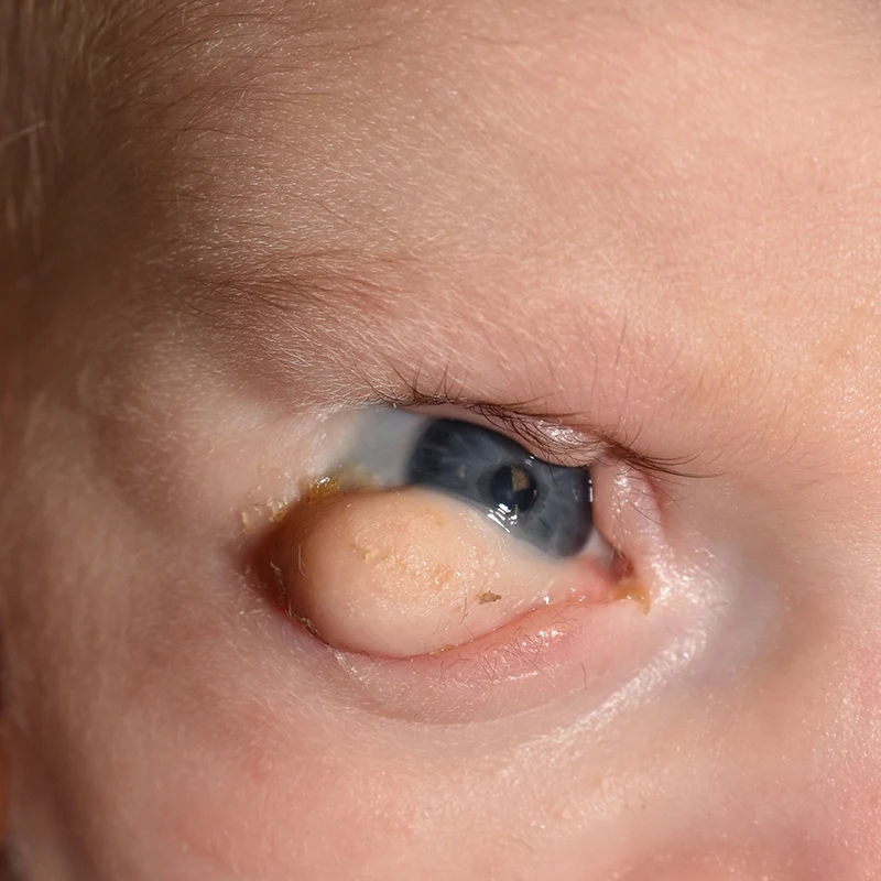 Appearance as an infant, age six months, prior to the first surgery on her eye; large inferior fornix lesion removed initially measured 2.2 cm x 1.5 cm x 0.4 cm 