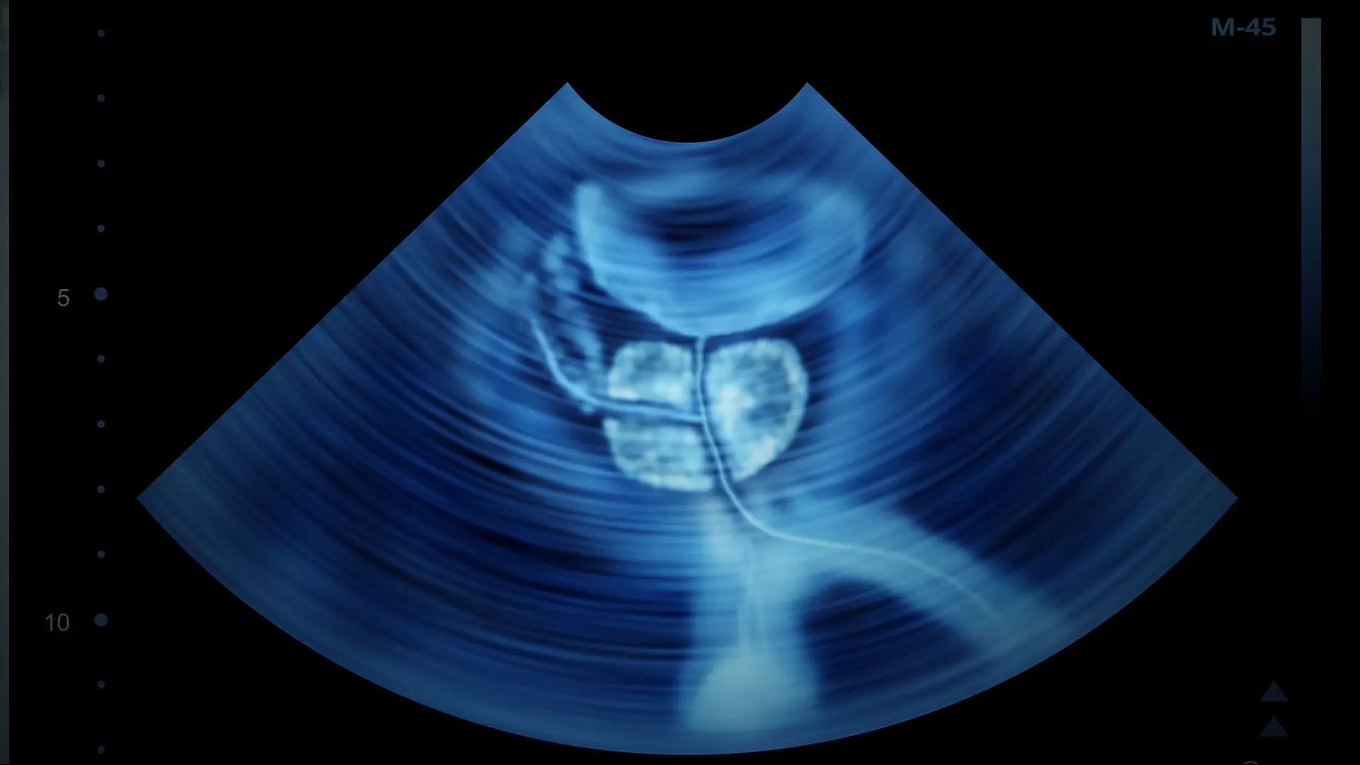 Mount Sinai Begins Offering High-Intensity Focused Ultrasound for Localized Prostate Tumors