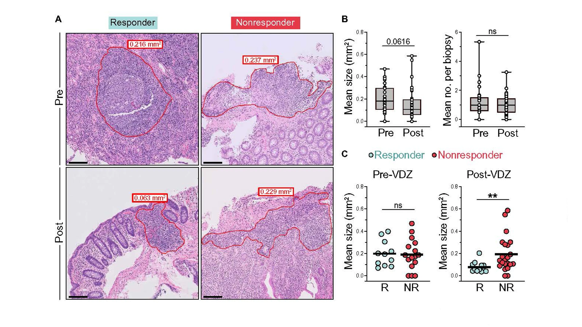 A) Representative hematoxylin and eosin staining of colonic biopsies from responder (R) and nonresponder (NR) patients with UC taken before and after VDZ therapy. Lymphoid aggregate (LA) border indicated with red line. Scale bars, 100 μm. (B) Mean LA size and number per biopsy from patients with UC pre- and post-VDZ therapy (cohort 2). Data are shown as box and whisker plots. (C) Comparison of LA size between VDZ responders and nonresponders in biopsies taken pre- and post-VDZ therapy. 