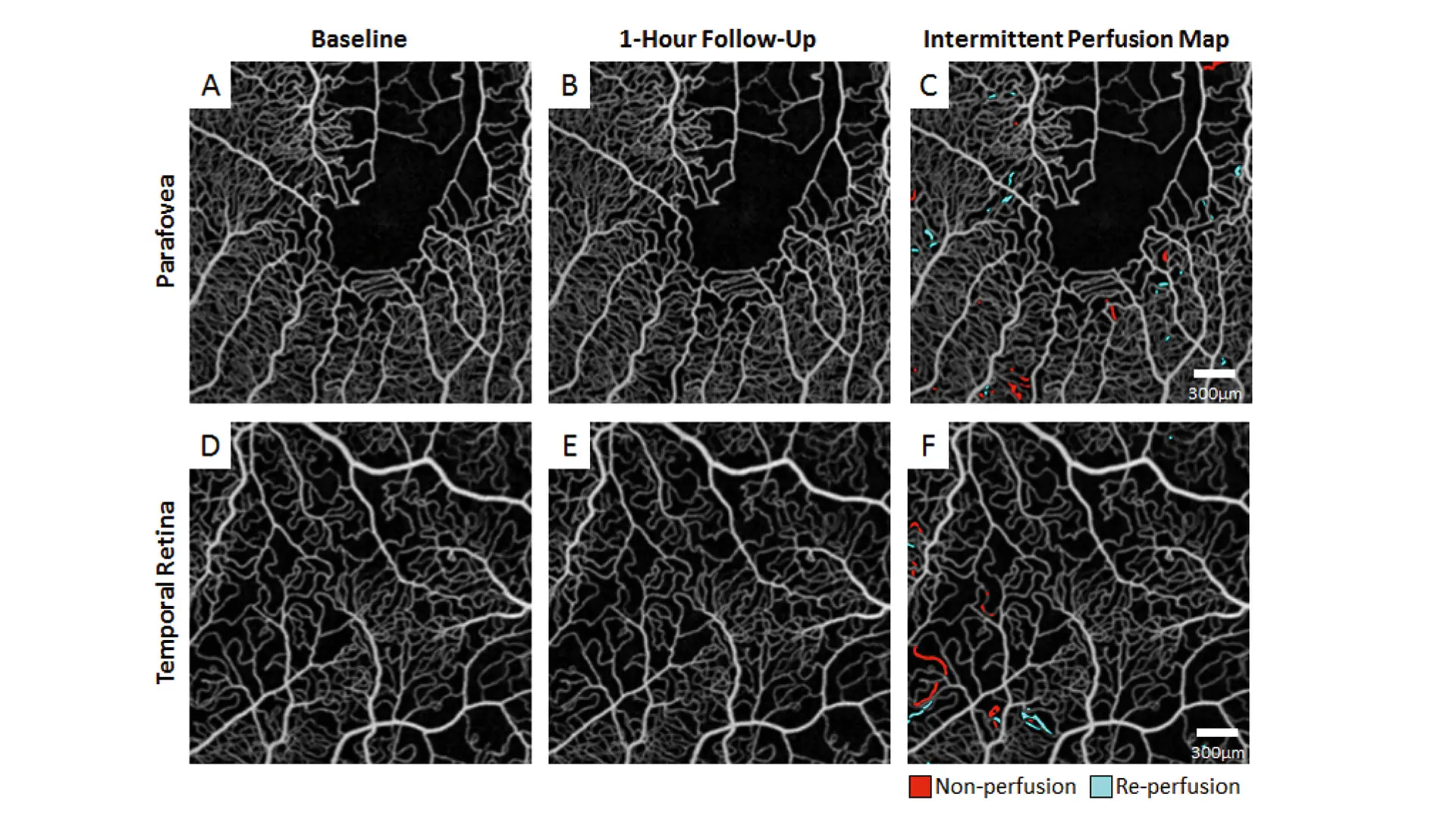 Innovative New Role for OCT Angiography Against Sickle Cell Retinopathy