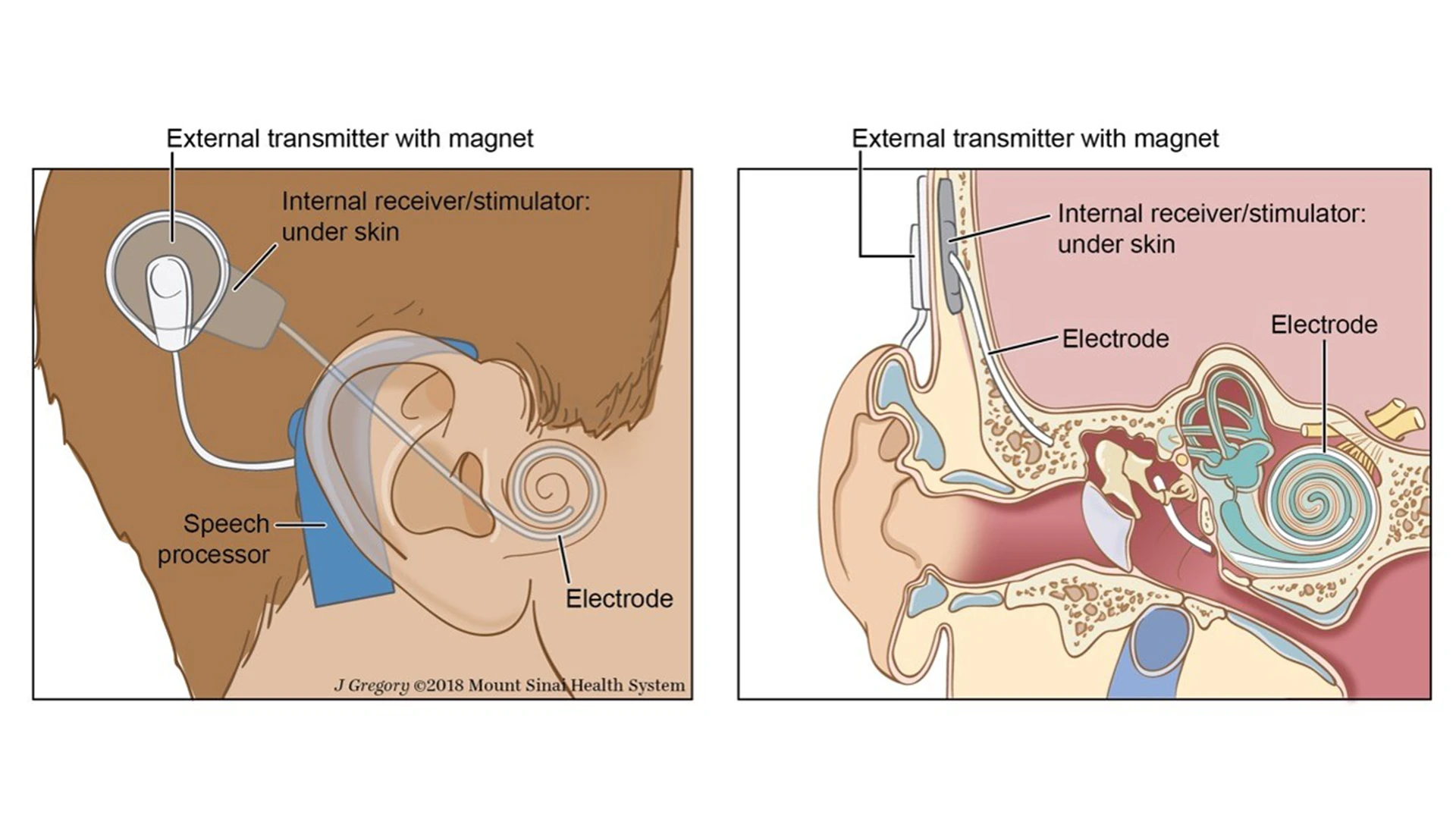 Cochlear implantation