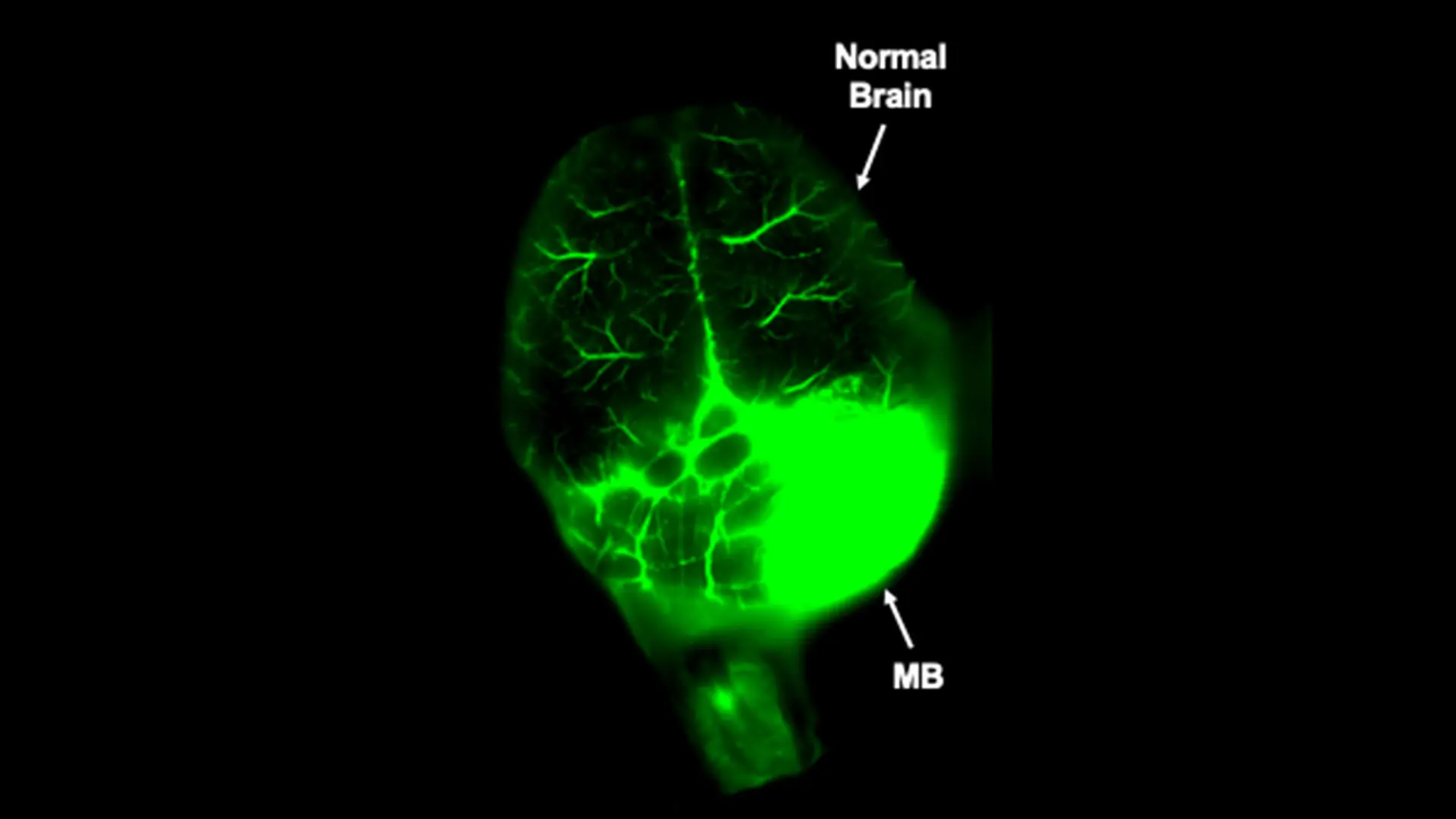 Fig. 5. Nano-targeted drug delivery (green) specifically to a medulloblastoma (MB) and not adjacent normal brain in a preclinical genetic brain tumor model with an intact blood-brain barrier.   