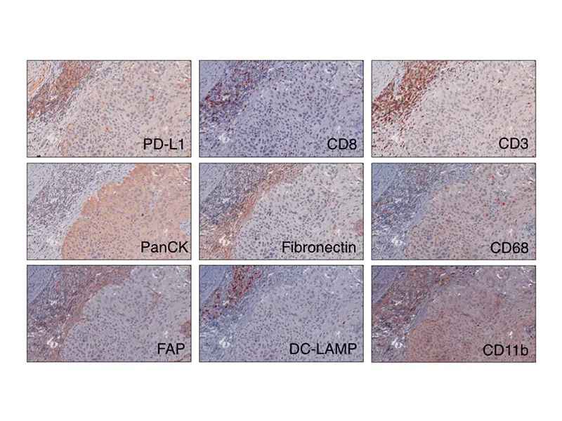 This analysis of the cellular composition of the bladder tumor microenvironment uses multiple immunohistochemical stains on a single slide to dissect the features associated with response and resistance to immune checkpoint blockade.