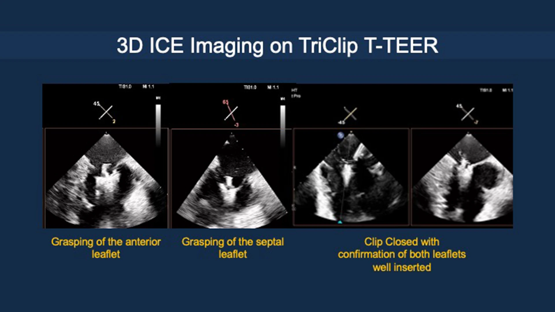 3-D  imaging on tricuspid transcatheter edge-to-edge repair.