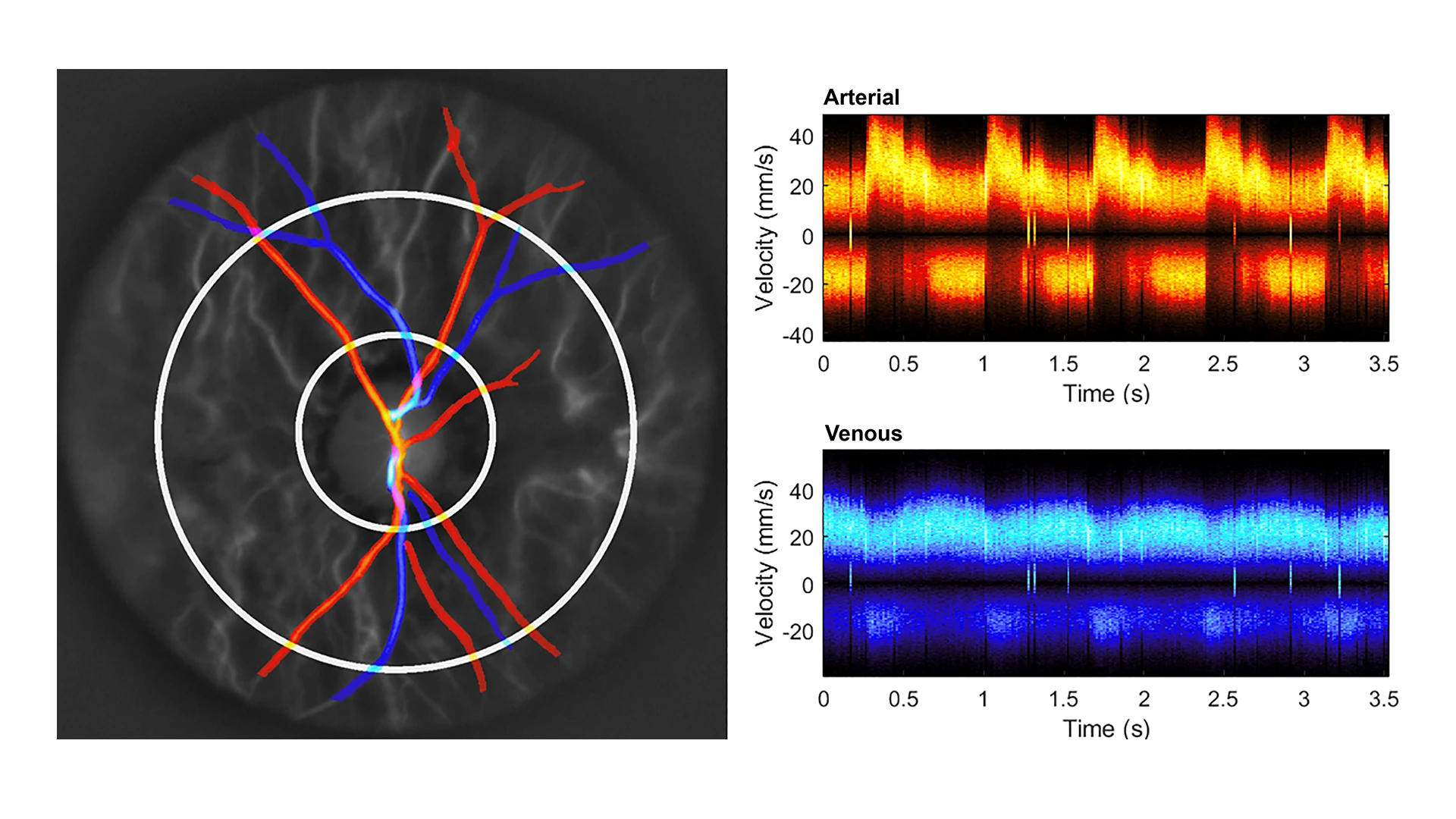 Same healthy control, exhibiting digitally elevated intraocular pressure
