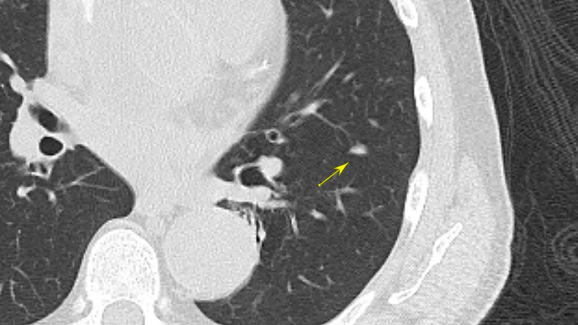 Triangular solid nodule: most likely a lymph node. The triangular shape and the location in the major fissure are characteristic of benign nodules.