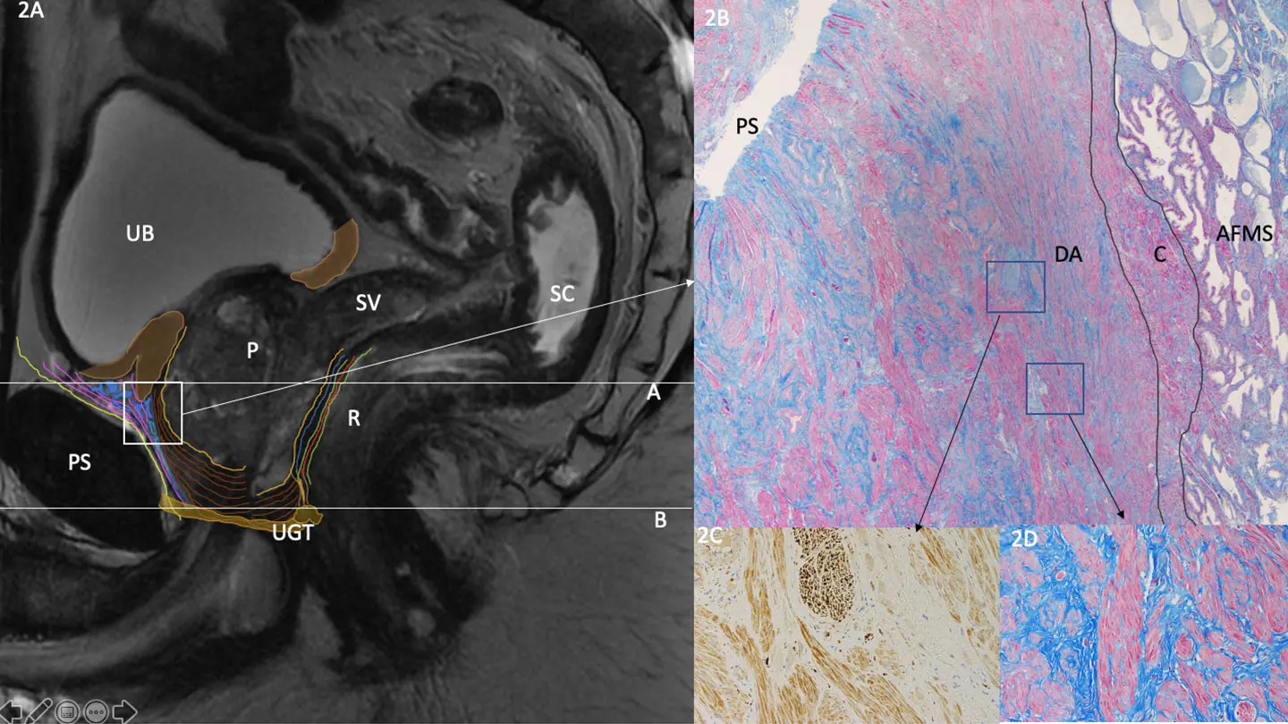 Sagittal Pelvic MRI with Detrusor Apron Histology
