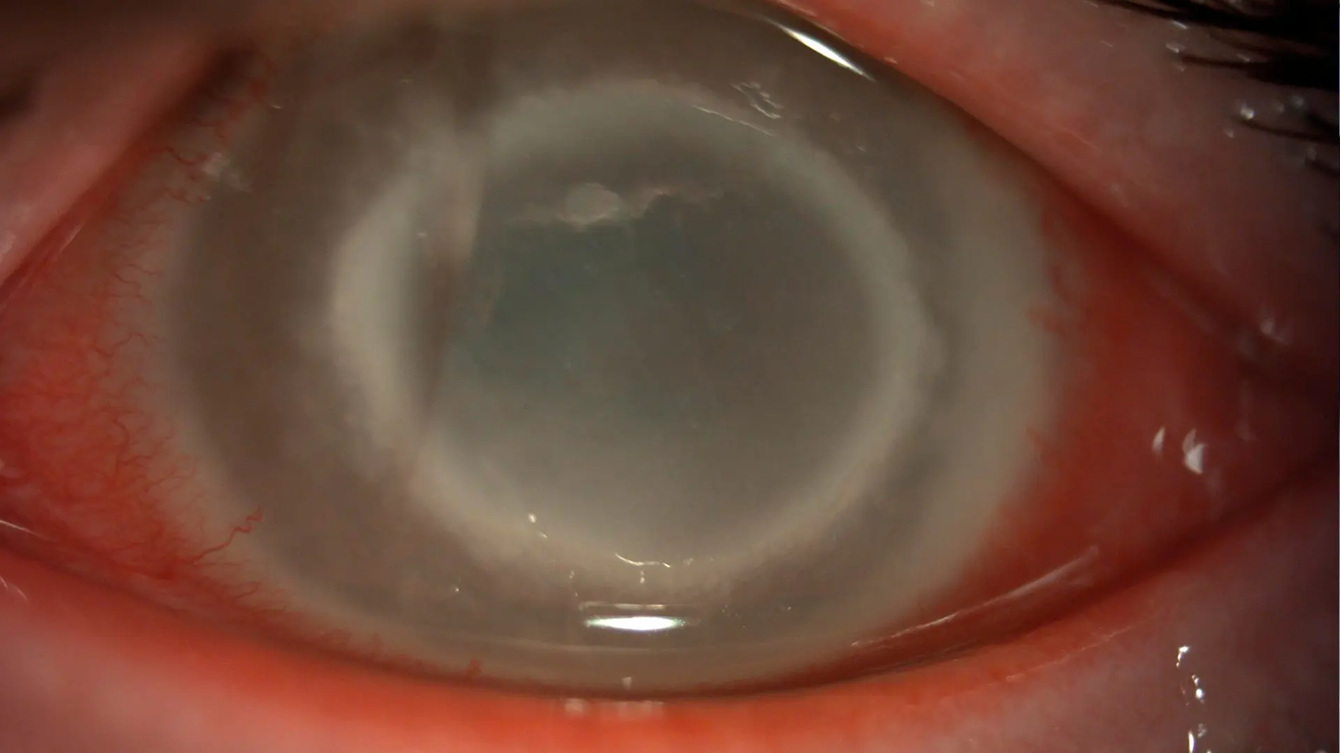 Fulminant acanthamoeba keratitis: Slit lamp photo of the left
 eye demonstrating large corneal ring infiltrate with
 diffuse stromal haze and edema. Visual acuity is 20/250.