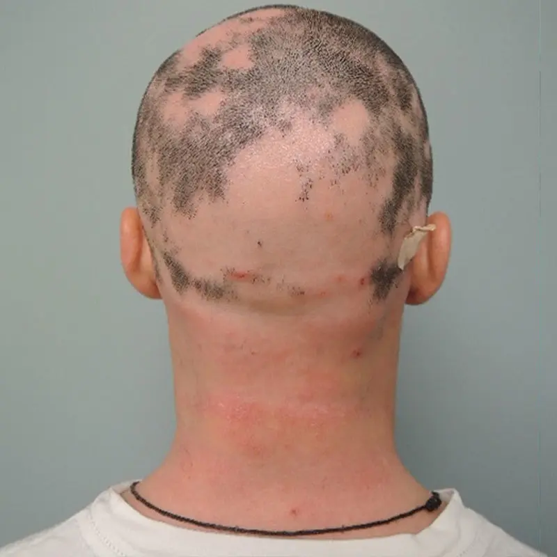 Patient with alopecia areata before treatment with JAK inhibitor