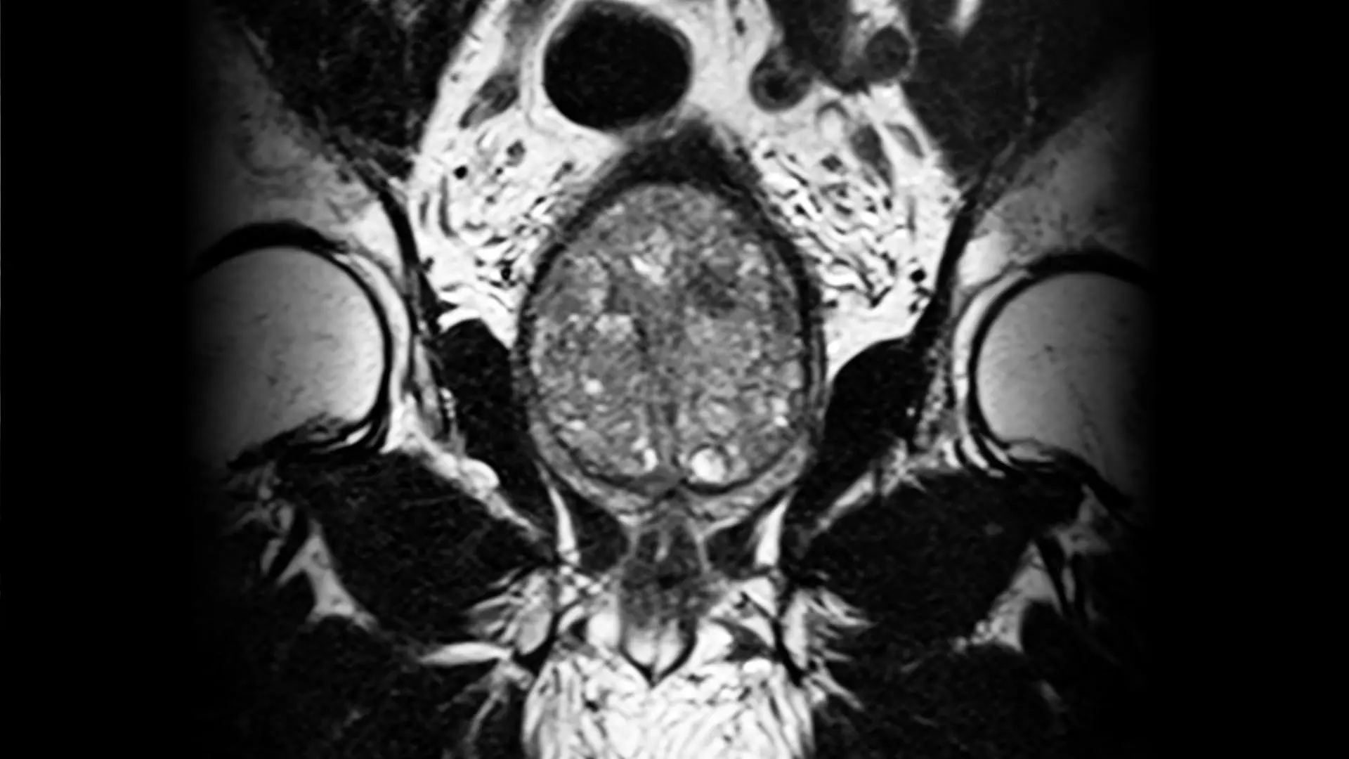 New Technologies, Initiatives Offer More Options for Management and Treatment of Benign Prostatic Hyperplasia