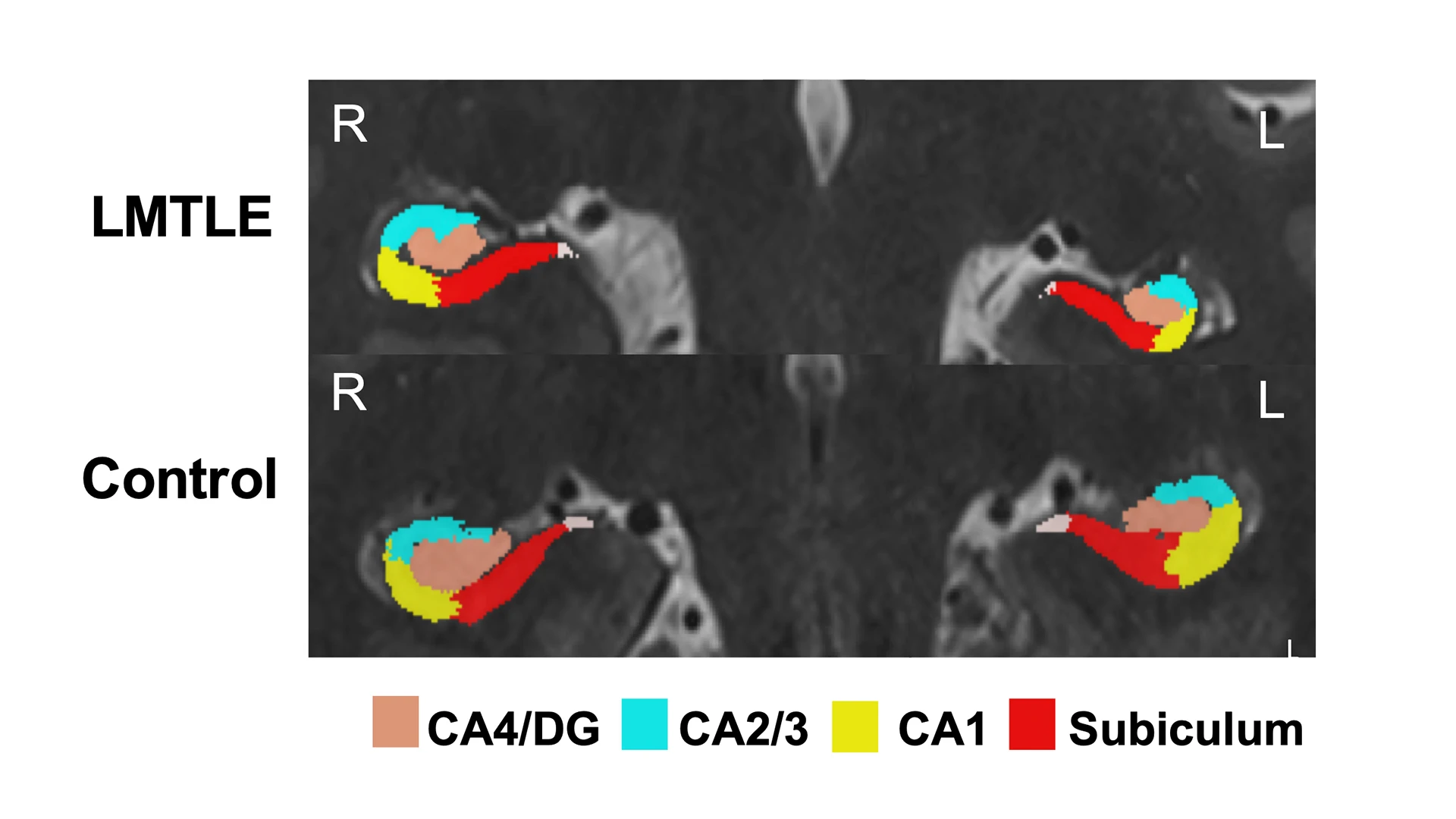 Figure 1. Hippocampal subfield segmentation for epilepsy patient and control. This compares hippocampal subfield volumes in a mesial temporal lobe epilepsy patient and a healthy control and demonstrates the level of detail achievable through high-resolution structural images. 