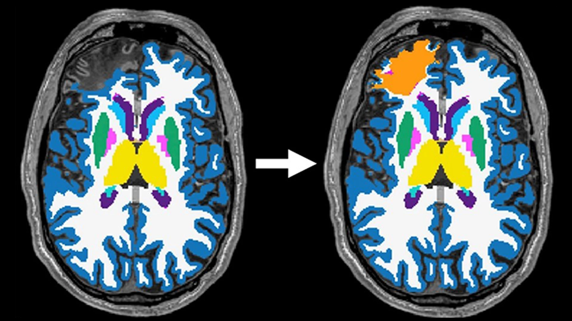 Developing Clinical Phenotypes to Better Understand Brain Injury