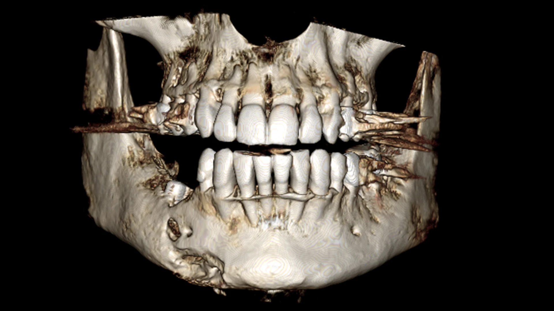 3D CT radiograph of the diseased mandible.