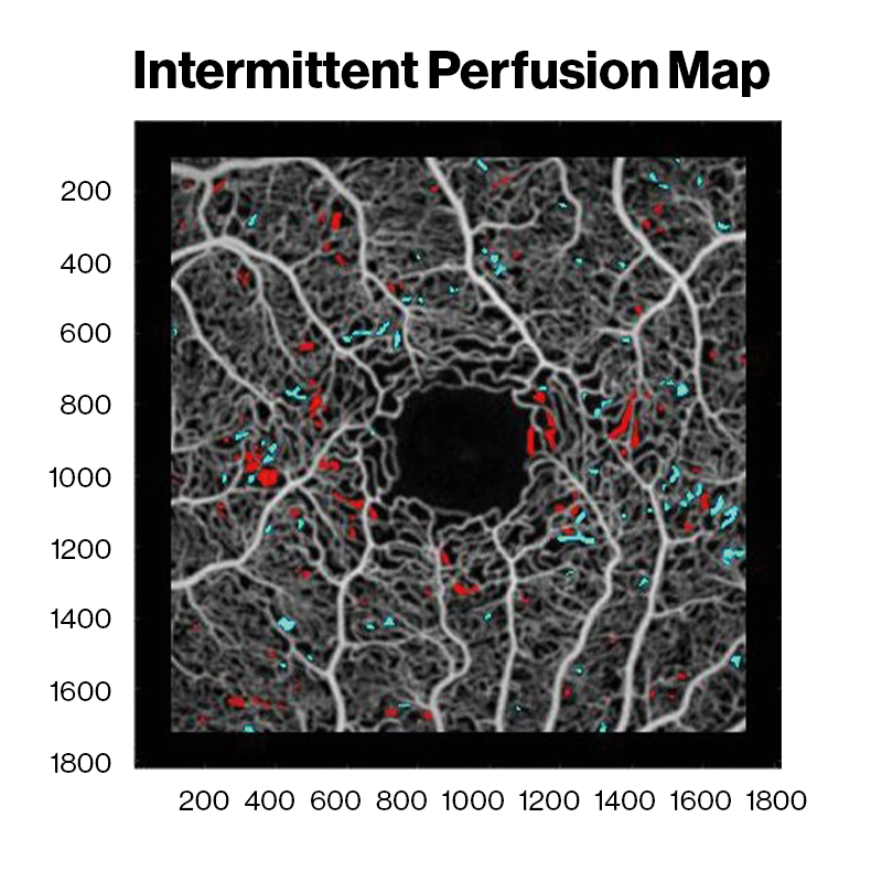 Averaged OCT angiography images of a sickle cell HbSC disease patient at David E. Marrus Adaptive Optics Imaging Laboratory. Red and cyan indicate capillary nonperfusion and reperfusion between sessions, respectively.