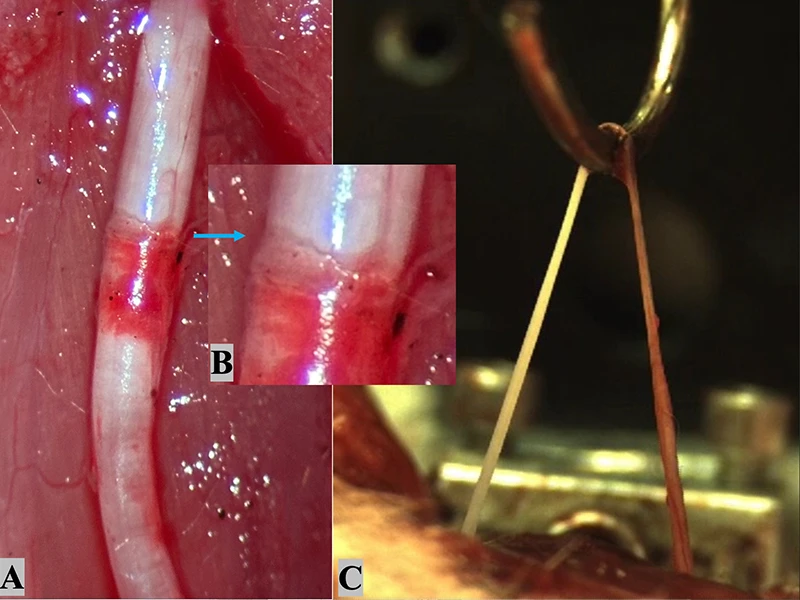 (A) After epineuroclasis, rupture of the epineurium and a subepineurial hematoma are visible with an exposed nerve core proximal to the epineurial tear zone (image taken with a smartphone camera). (B) A magnified view of the epineurial tear zone reveals the sharp edge of the disrupted epineurial sheath. (C) Macroscopic continuity is maintained immediately after endoneuroclasis (screenshot from filmed load-to-failure experiment). The exposed nerve core (left of the hook) appears white, whereas the area with an epineurial sheath (right of the hook) shows a red color.